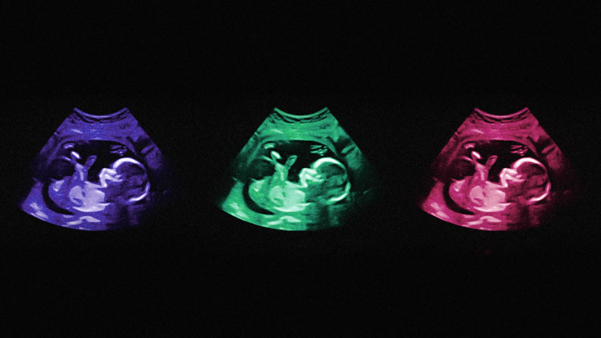 Sonography image of a baby